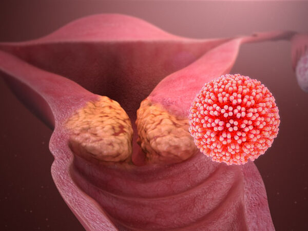HPV_causing_cervical_cancer