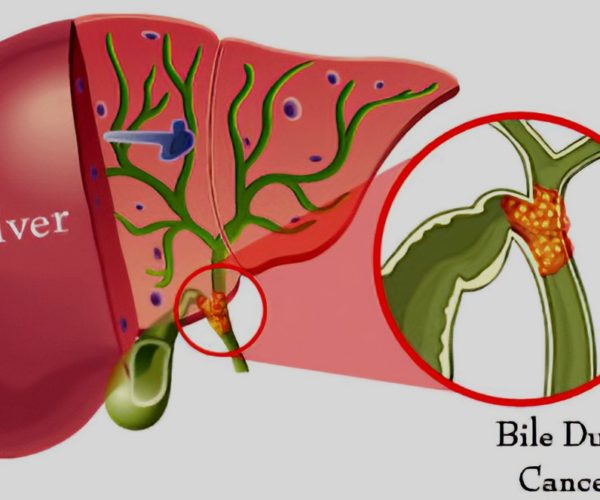 bile-duct-cancer