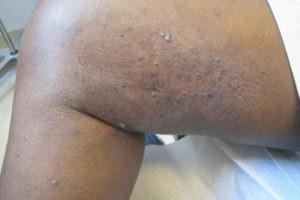 swollen lymph nodes in groin hiv